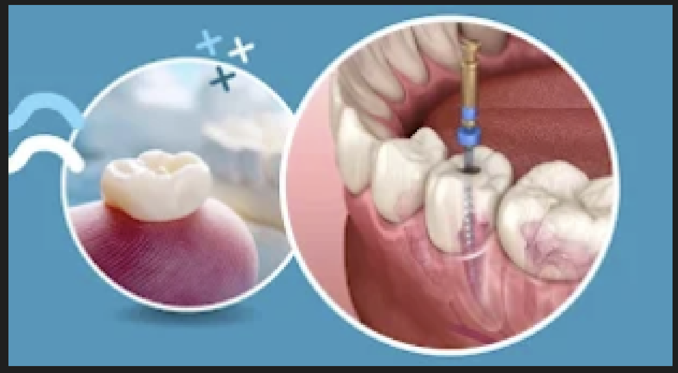 Root canal treatment at Dr Oswal's Dental Clinic Ravet