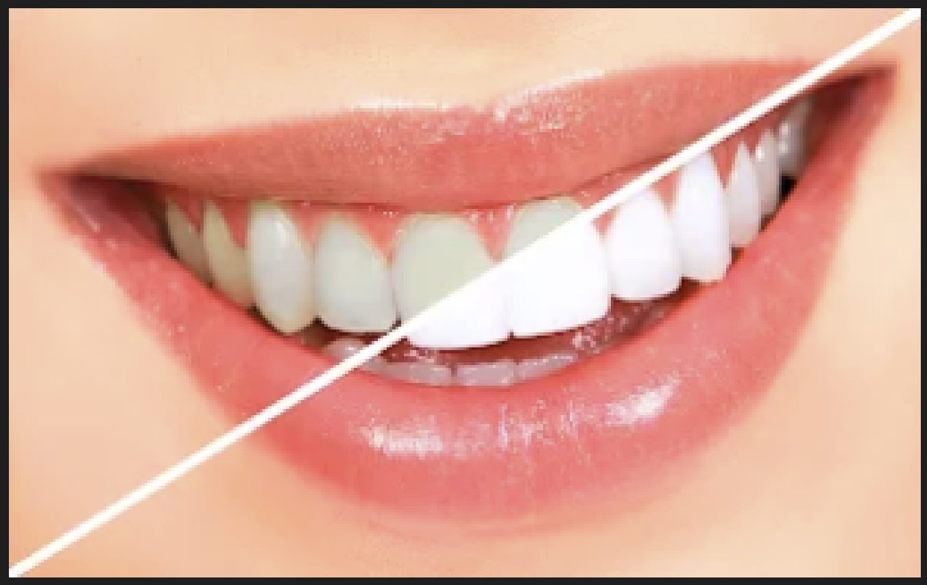 Professional teeth whitening treatment at Dr Oswal's Dental Clinic Ravet