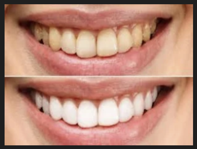 Professional Teeth Cleaning - Dr Oswal's Dental Clinic Ravet