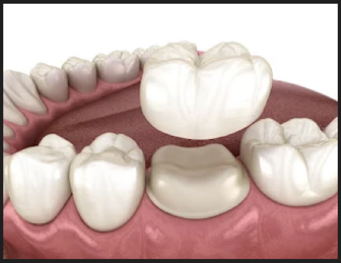 Dental crowns and bridges at Dr Oswal's Dental Clinic Ravet