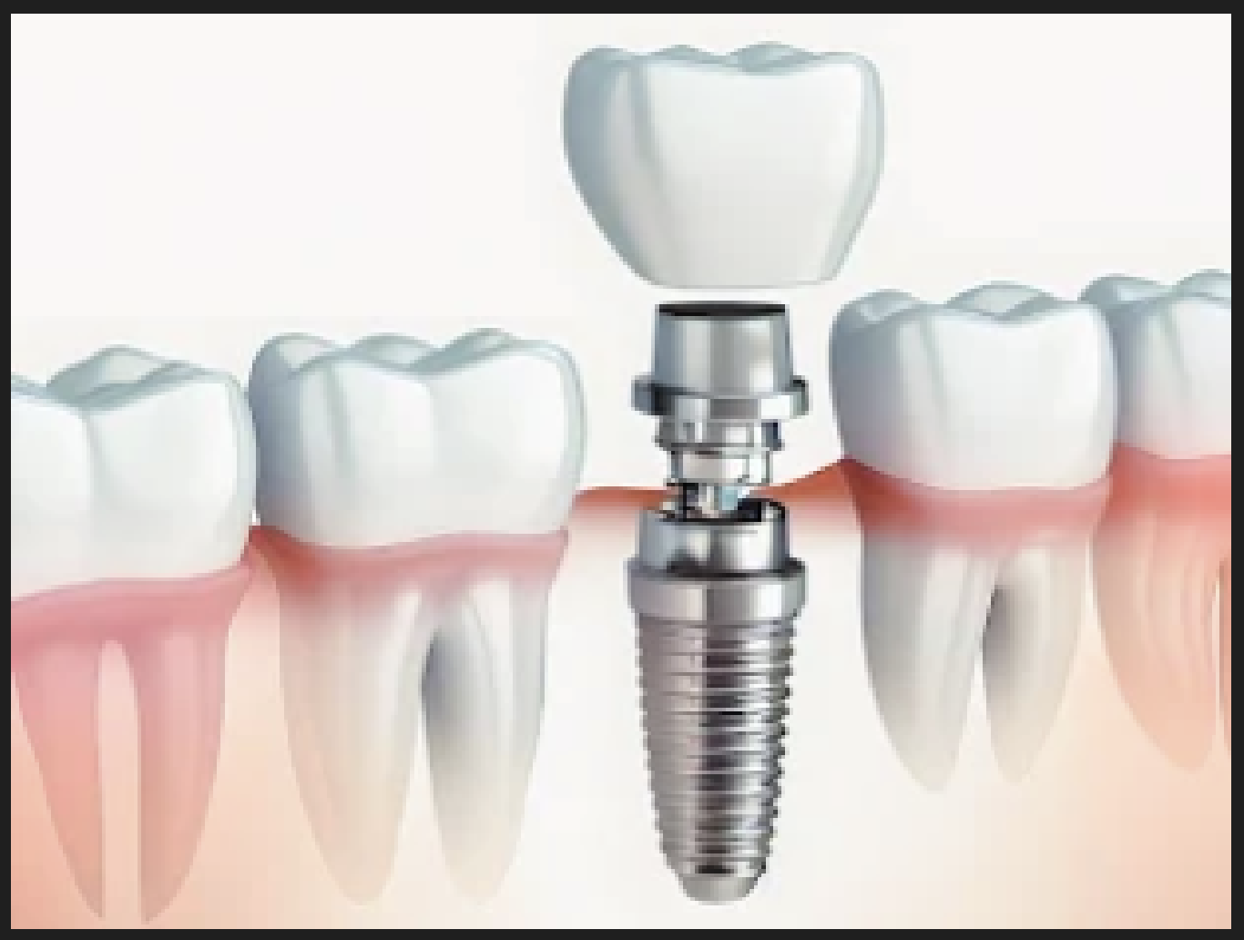 Dental implants procedure at Dr Oswal's Dental Clinic Ravet